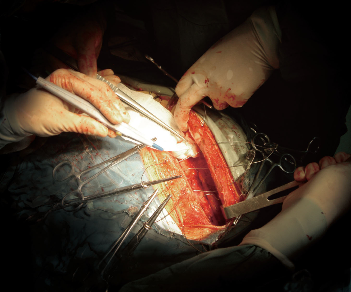 1517993061469519.jpg 12改胸骨縫合鋼絲曲.jpg